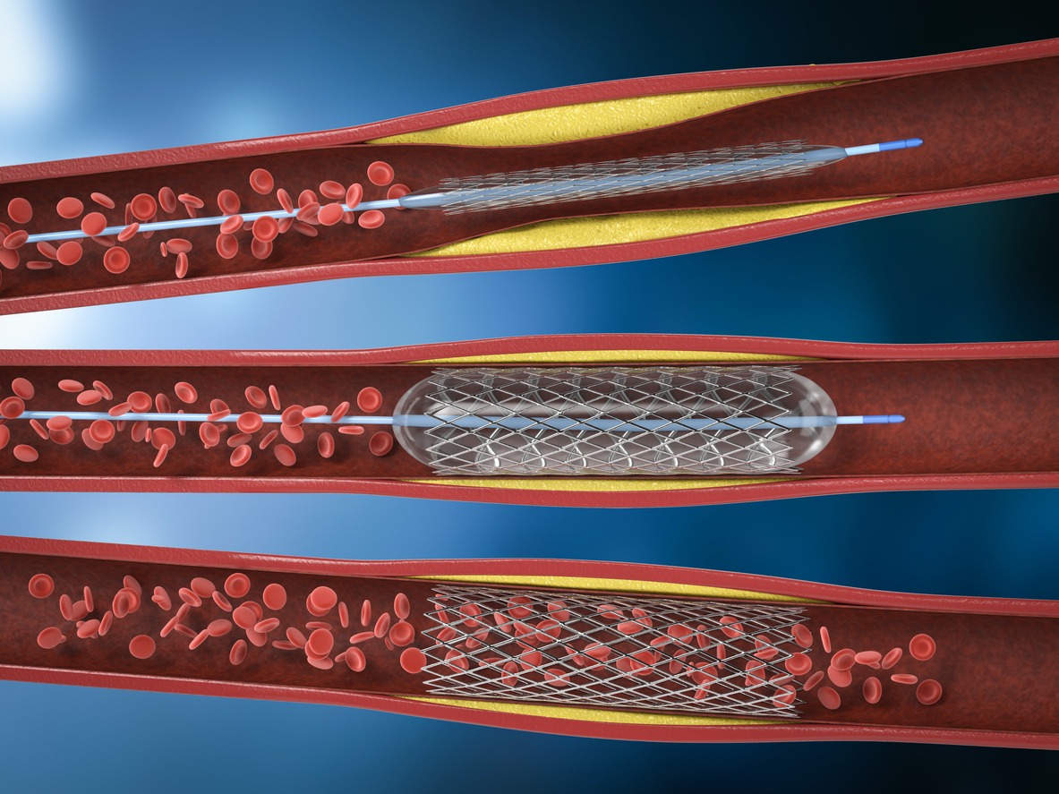 angioplasty