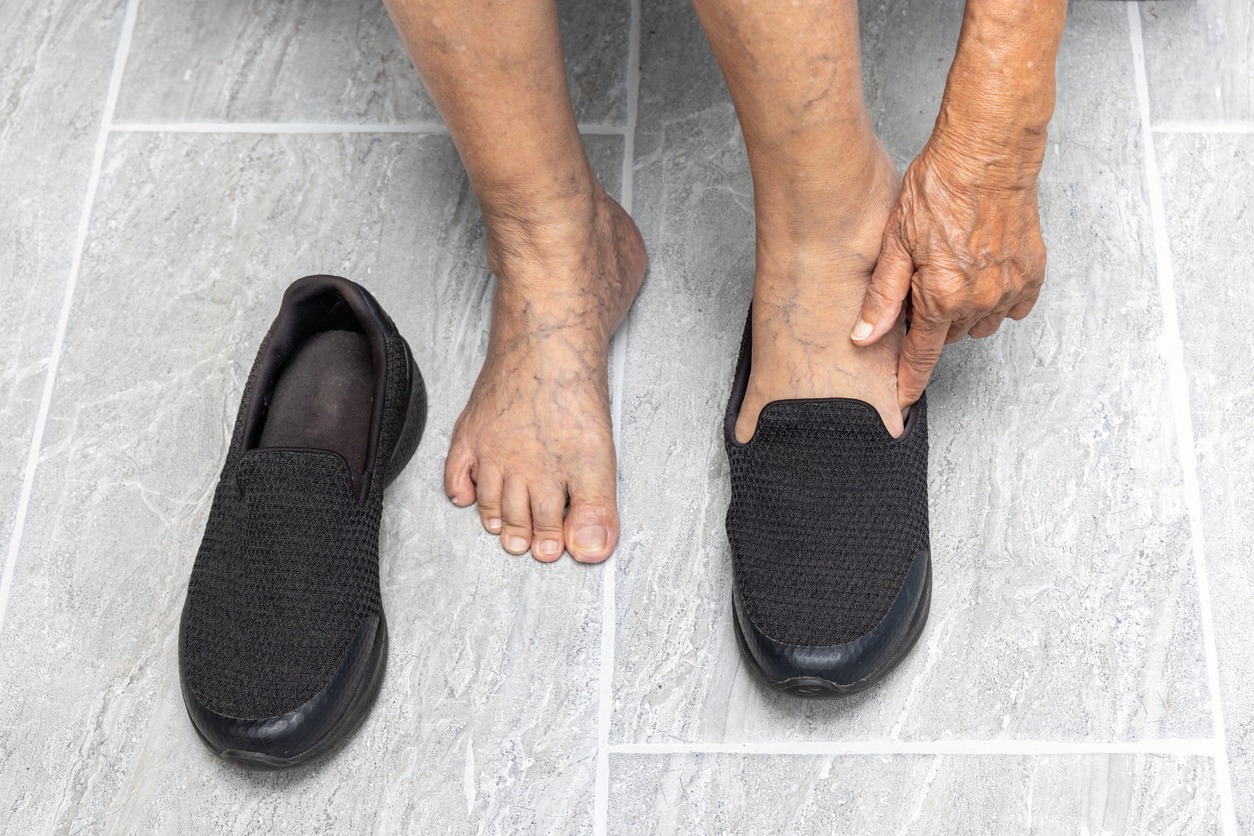 feet with varicose veins