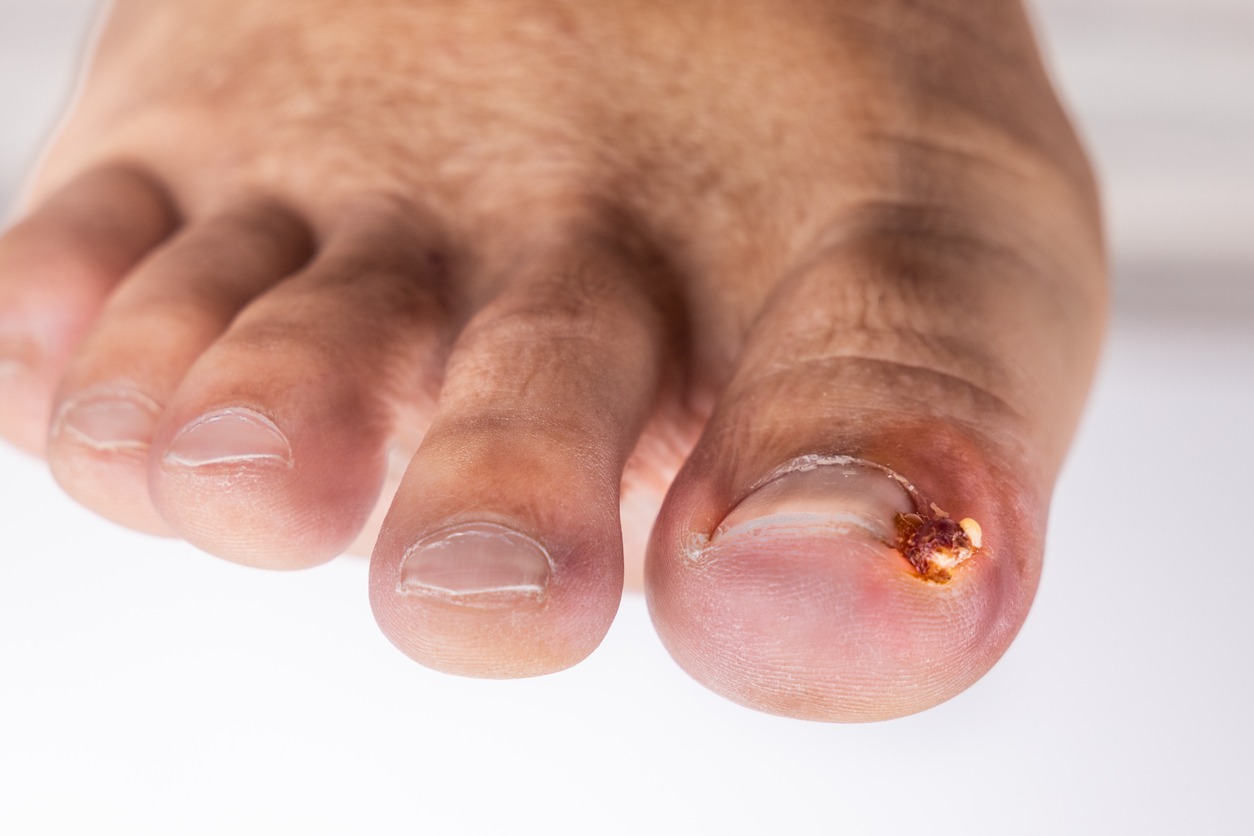 ingrown toenail