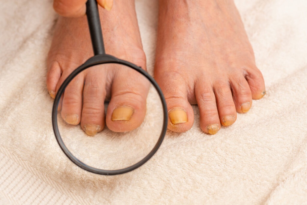 woman with onychomycosis