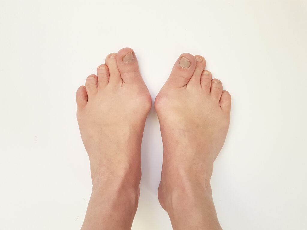 severe bunions