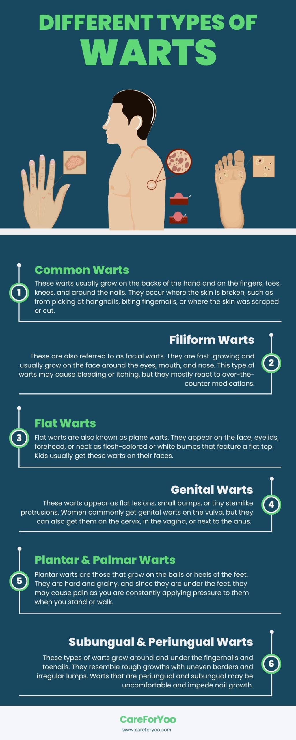 Different Types of Warts