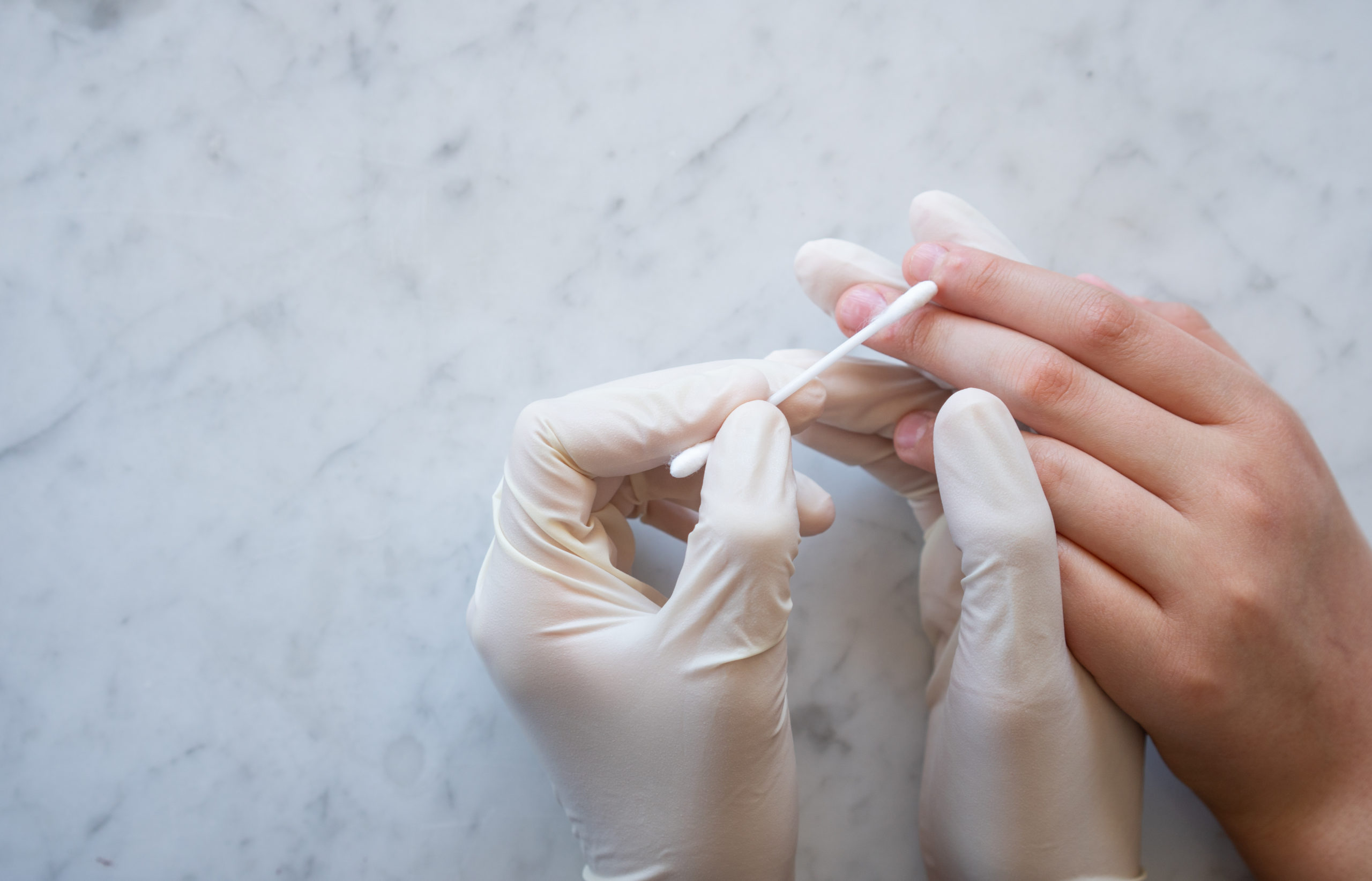 treating warts on the finger