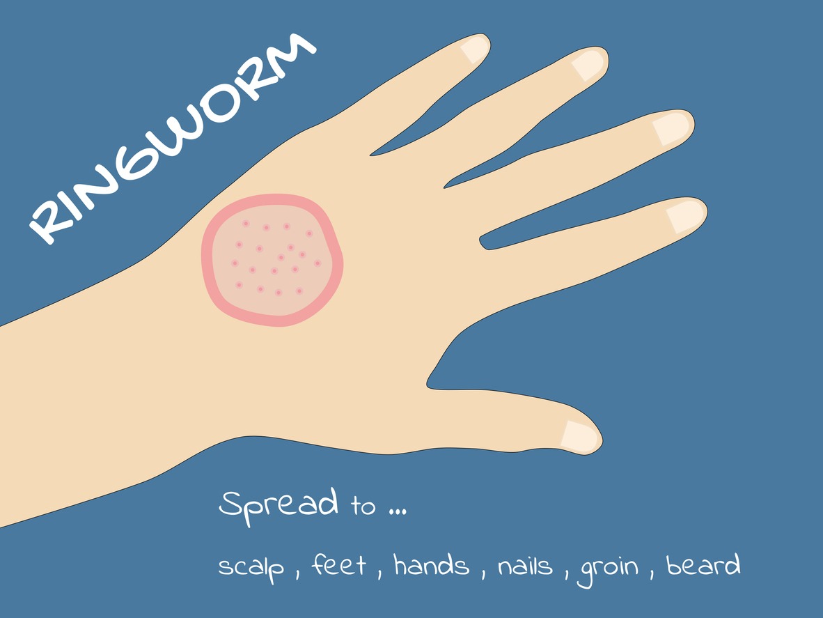 an illustration of ringworm