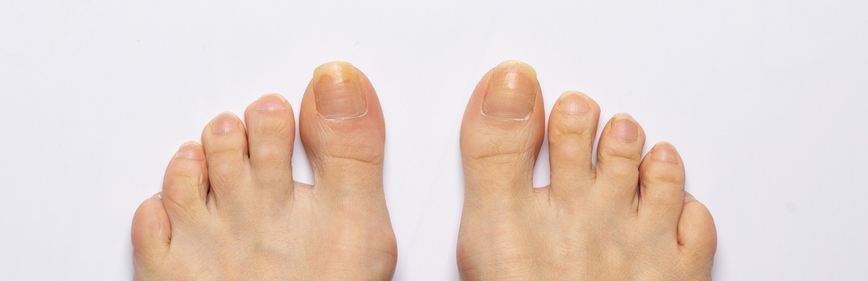 nails affected by fungal infection