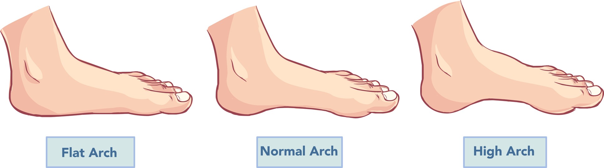different types of foot arches