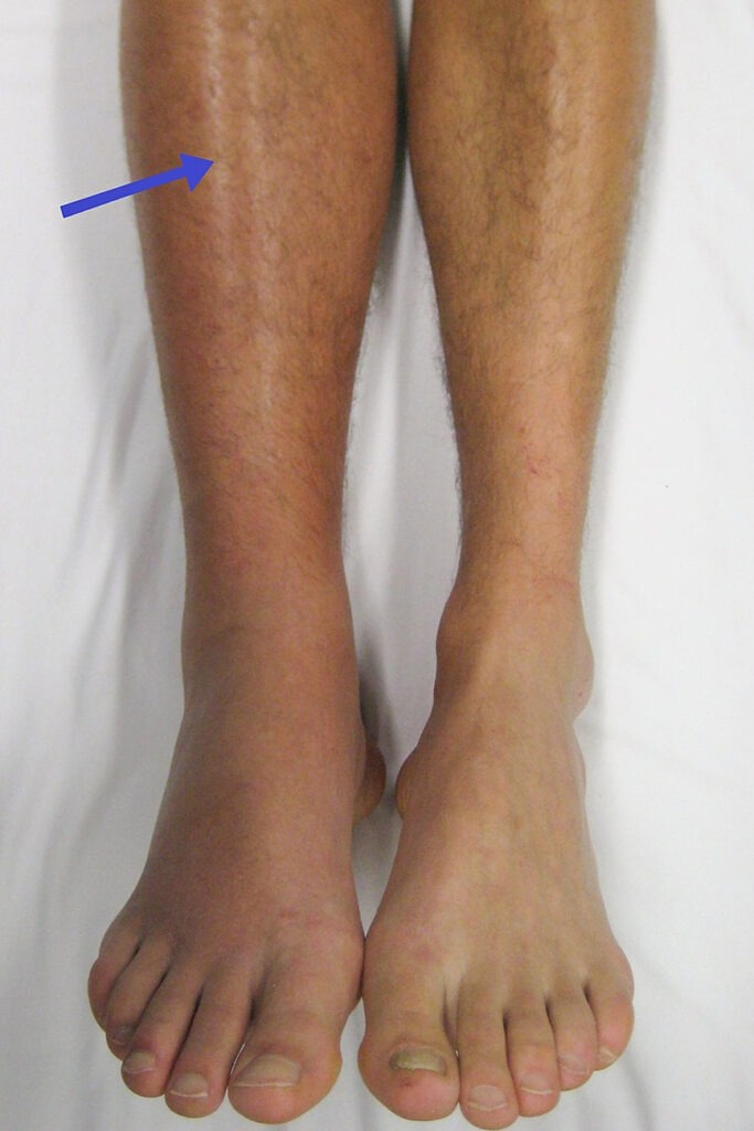 A Deep Vein Thrombosis of the right leg. Note the swelling and redness.
