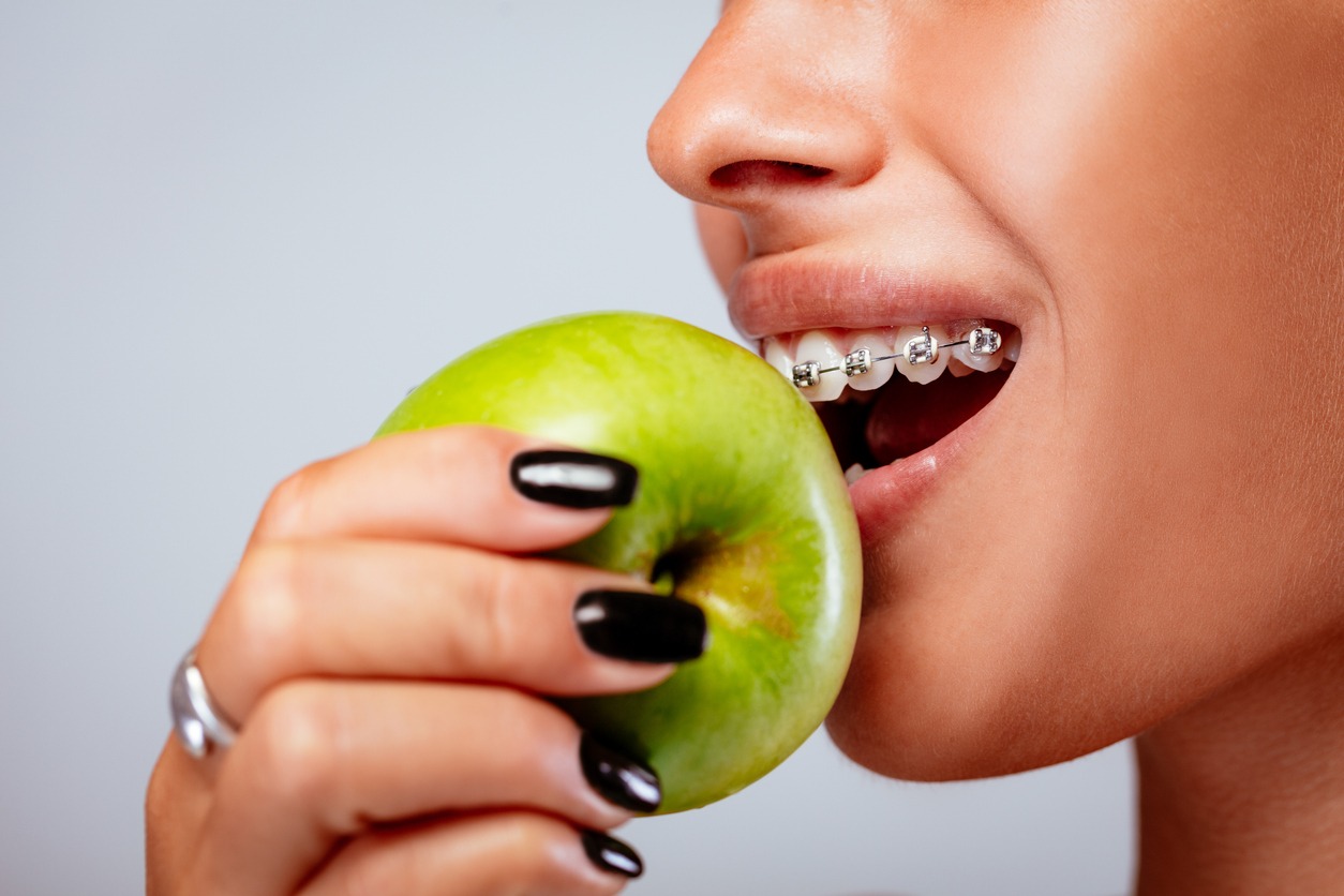 person with braces taking a bite on an apple