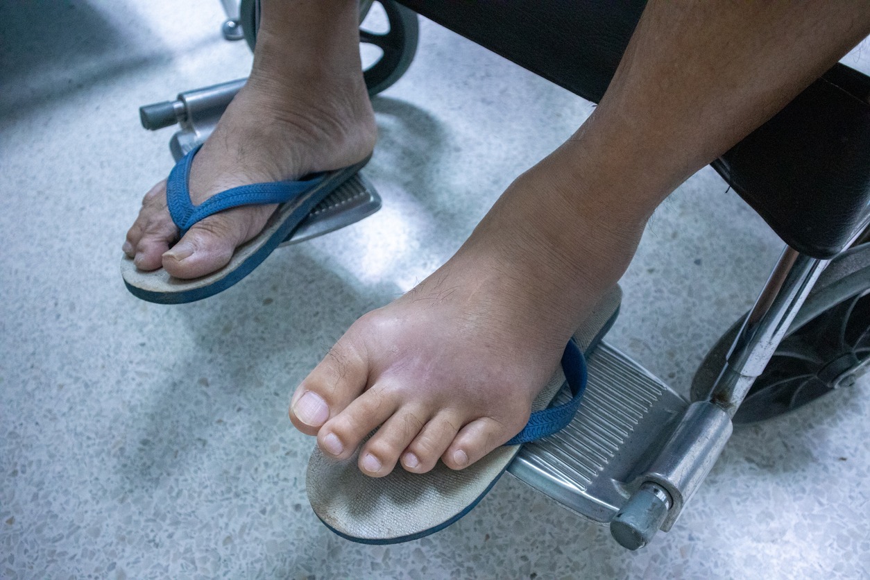 a patient suffering from gout on the foot