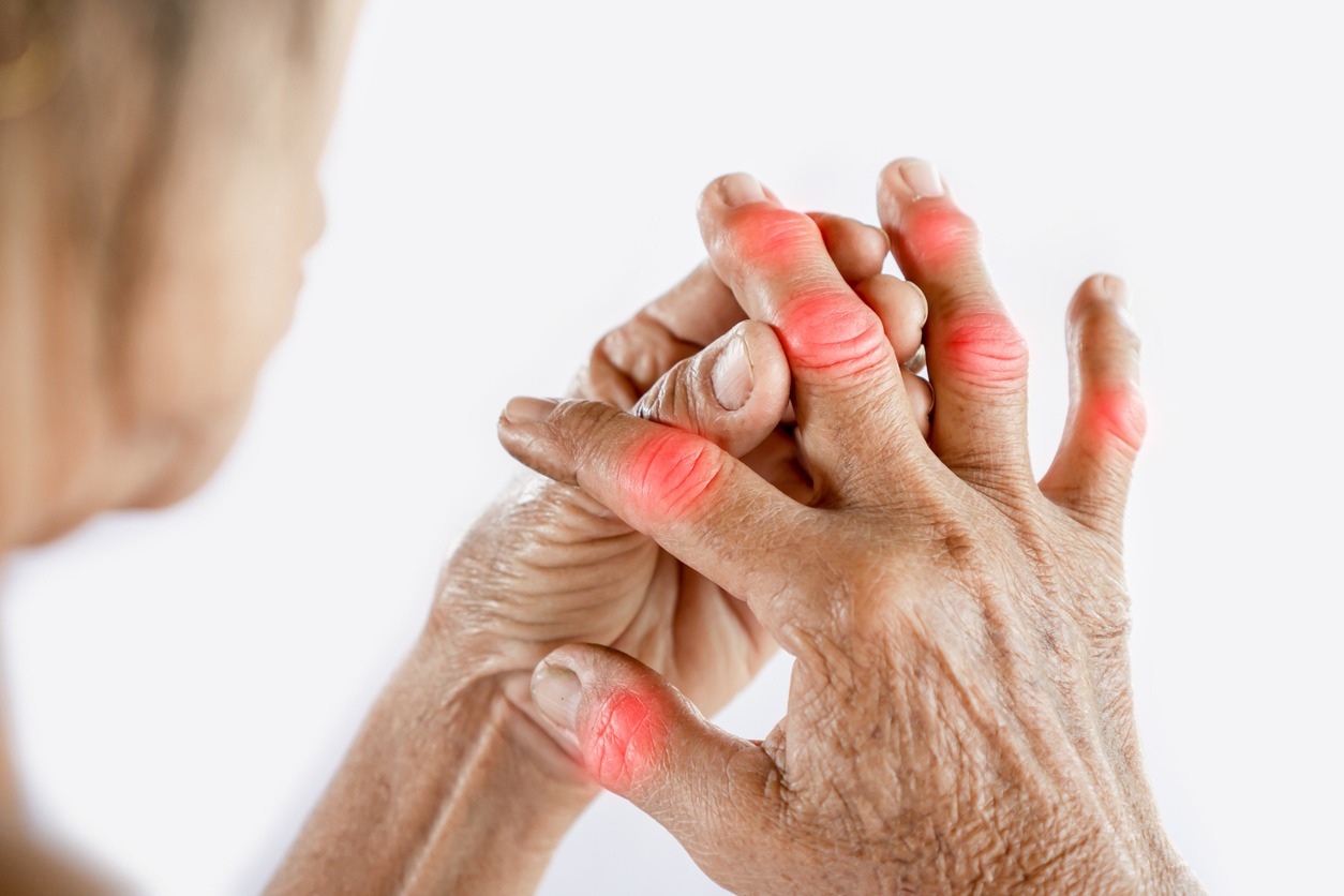 person suffering from gout on the fingers