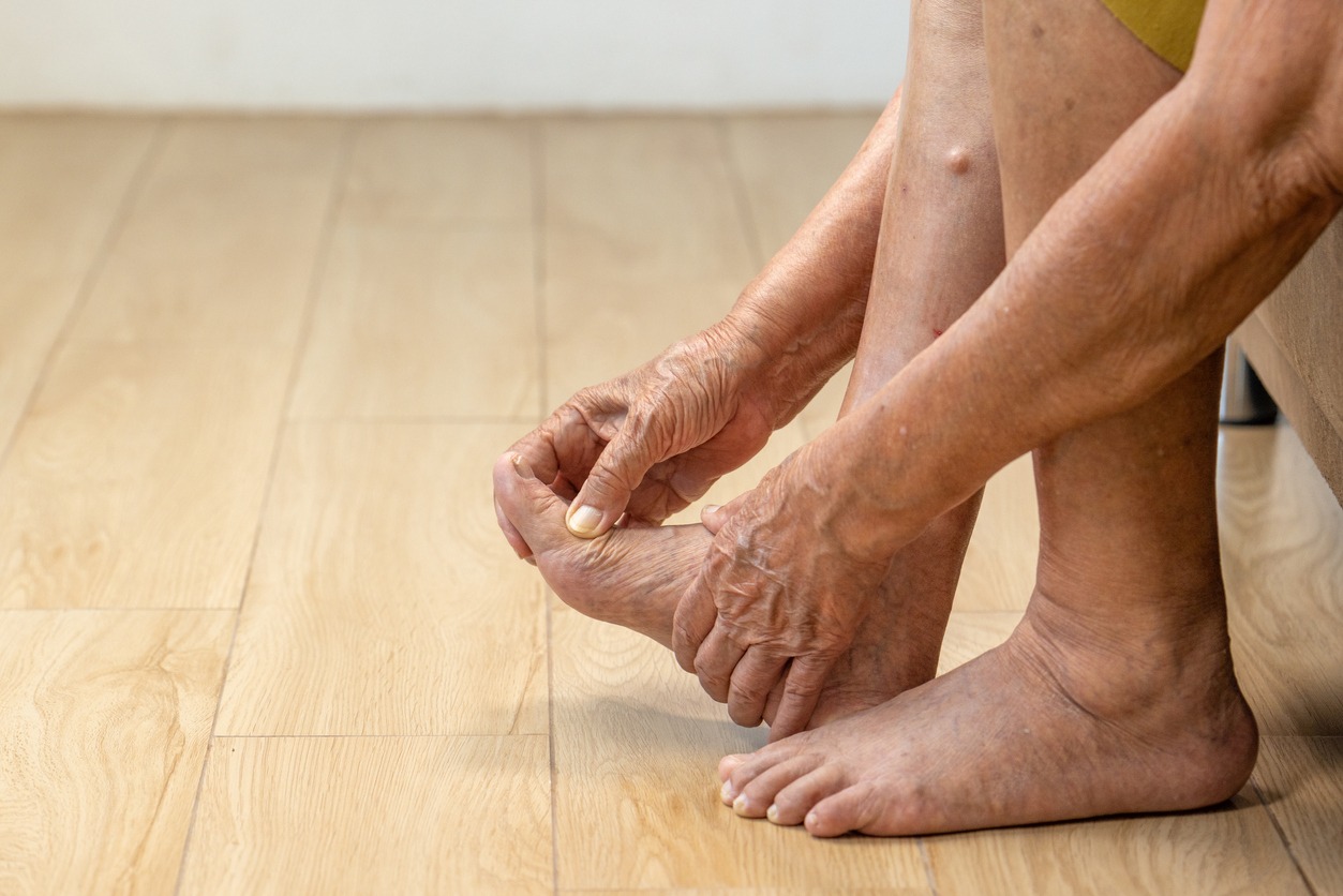 person with swollen foot due to gout