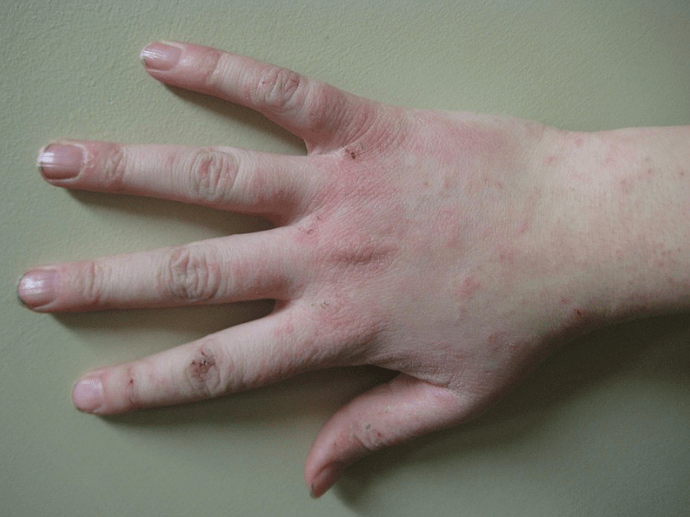 Human_hand_with_dermatitis