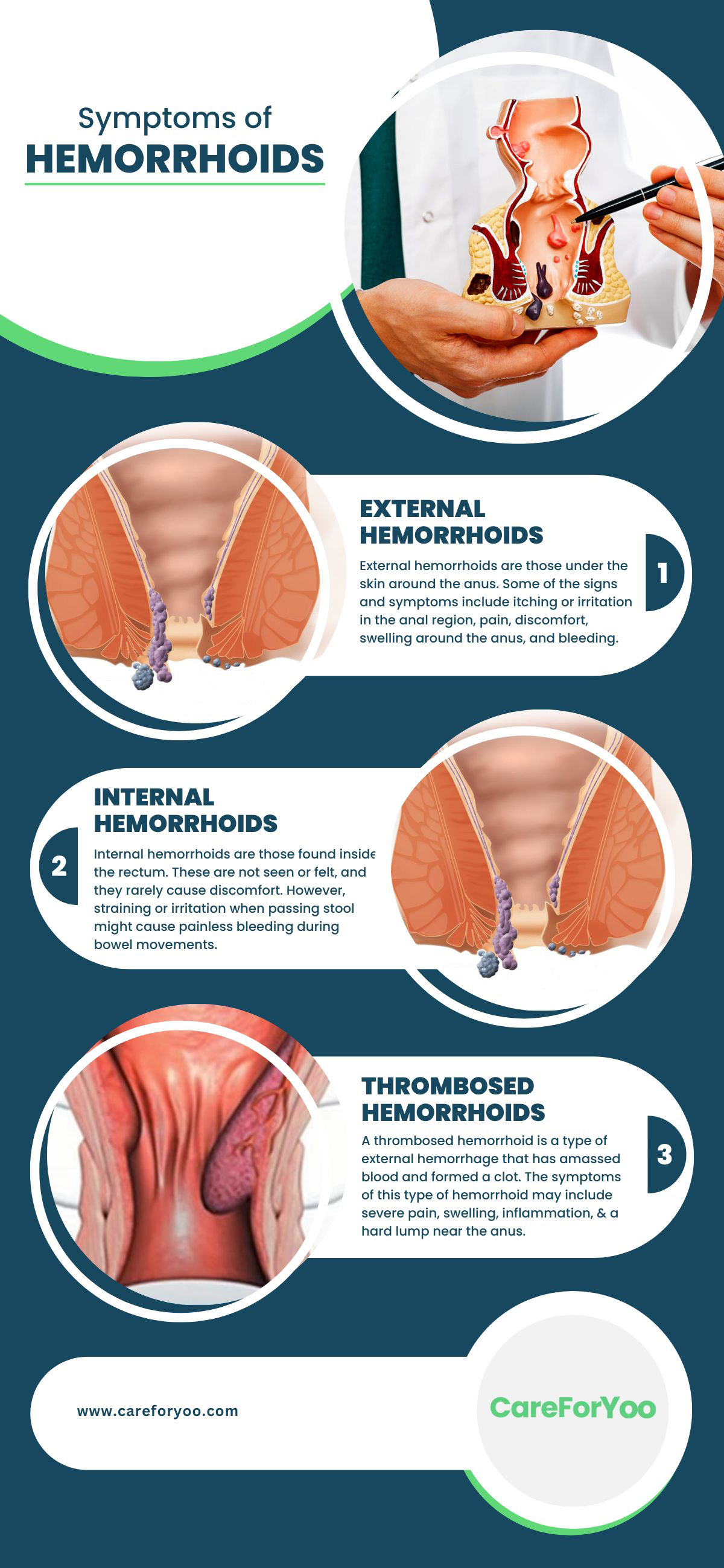 Symptoms of Hemorrhoids