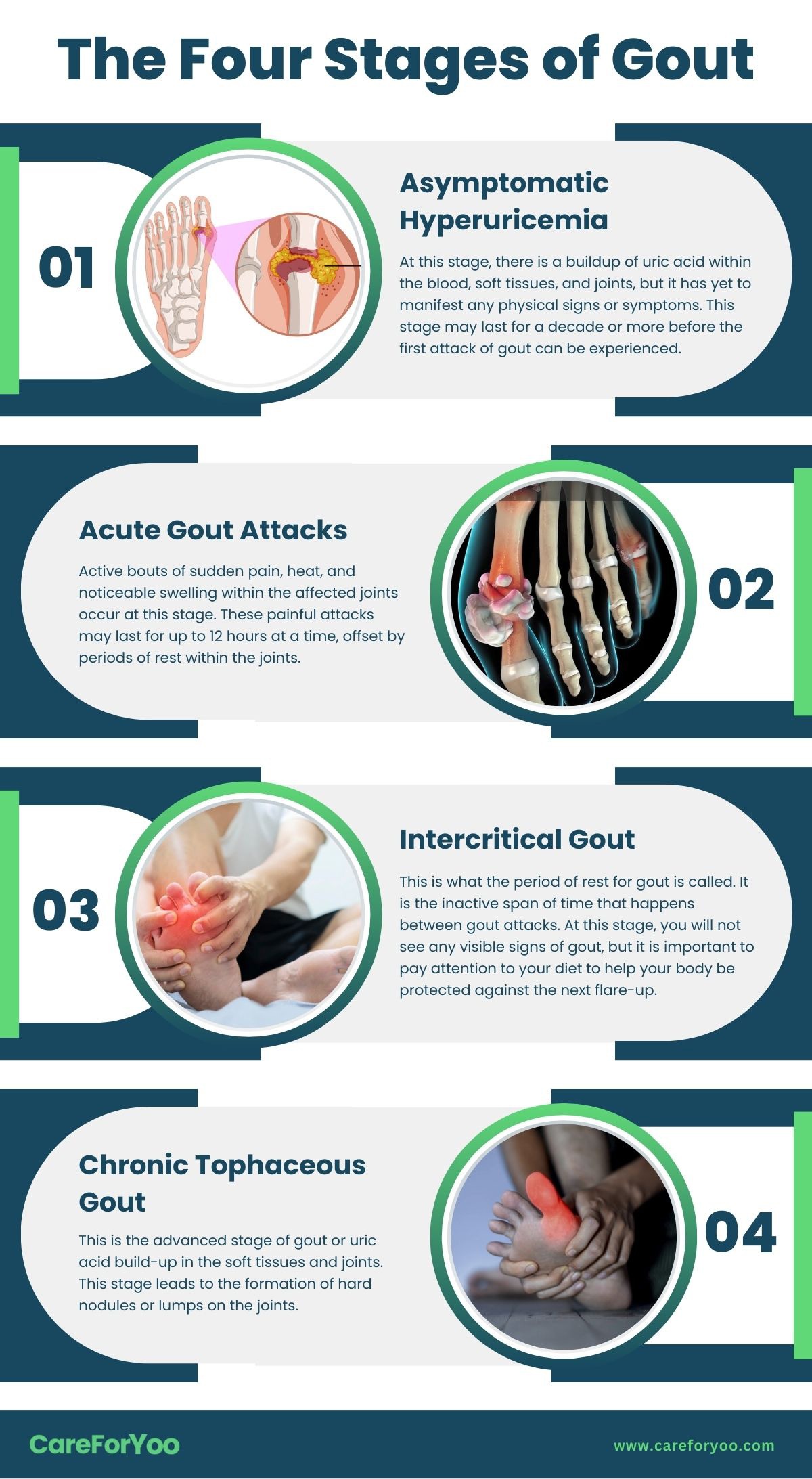 The Four Stages of Gout