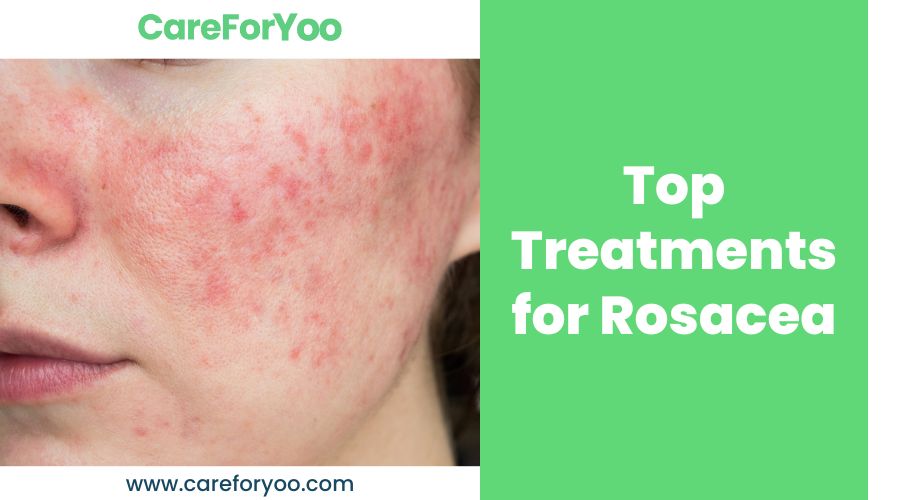 Top Treatments for Rosacea