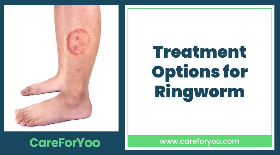 Treatment Options for Ringworm