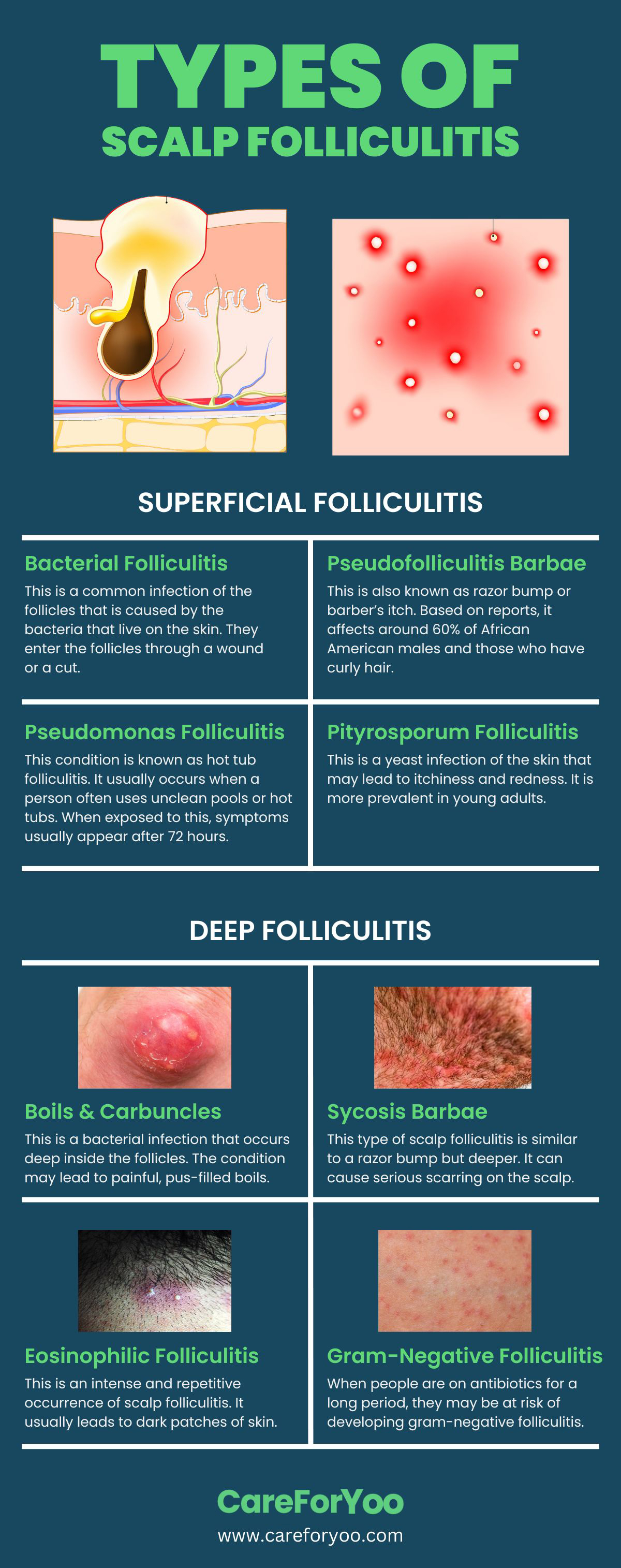 Types of Scalp Folliculitis
