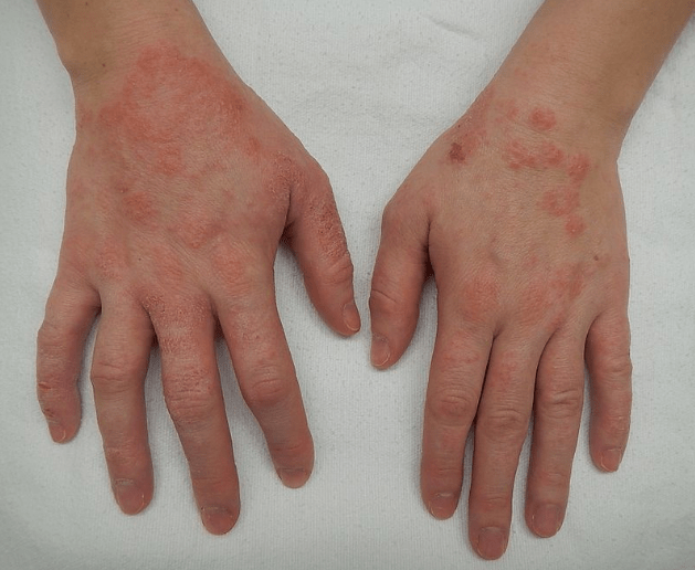 What is the Best Treatment of Eczema