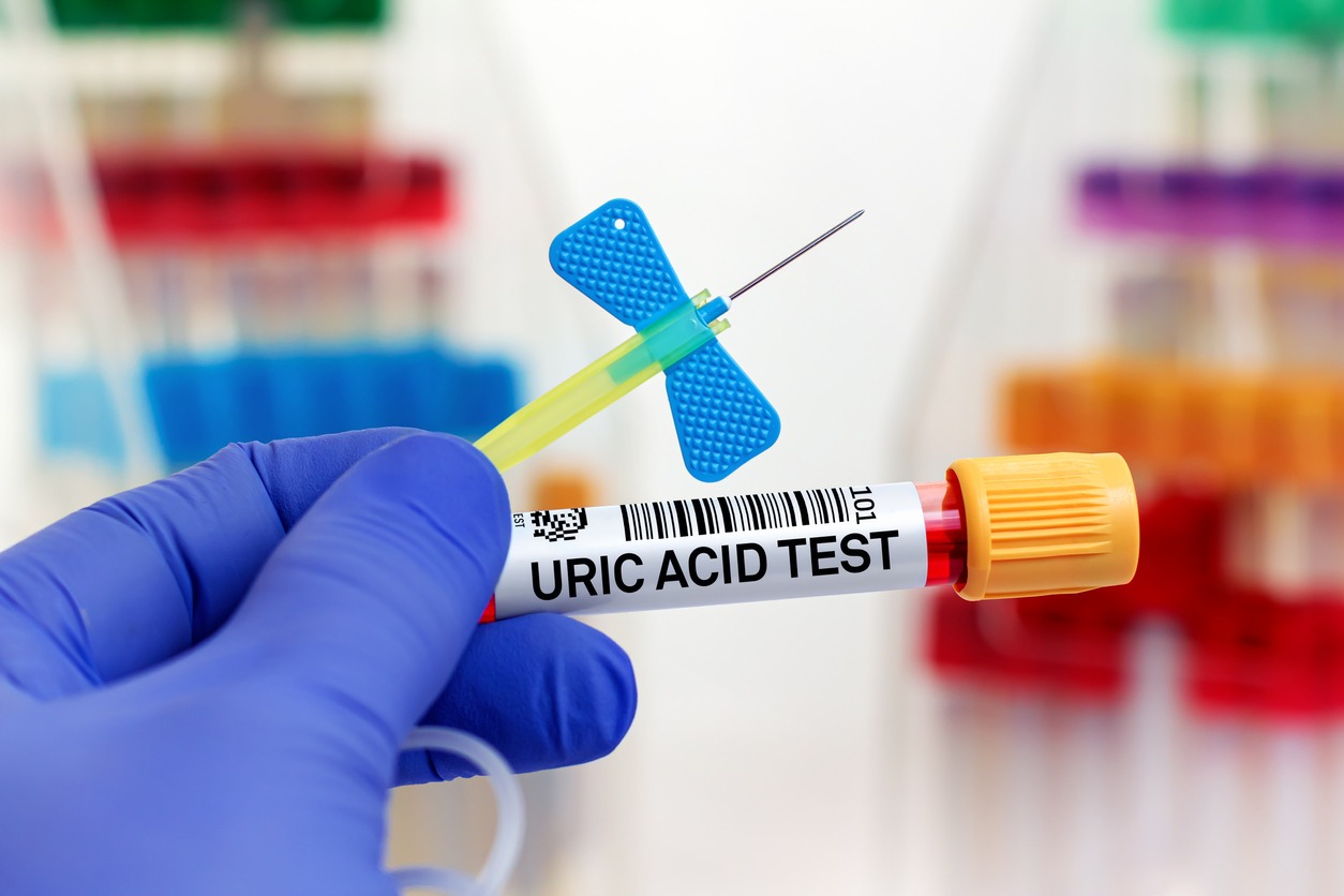 a blood tube labeled uric acid test