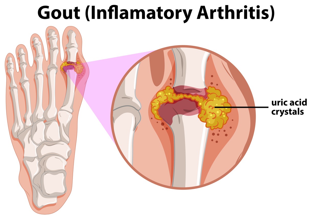 a diagram showing gout in human foot