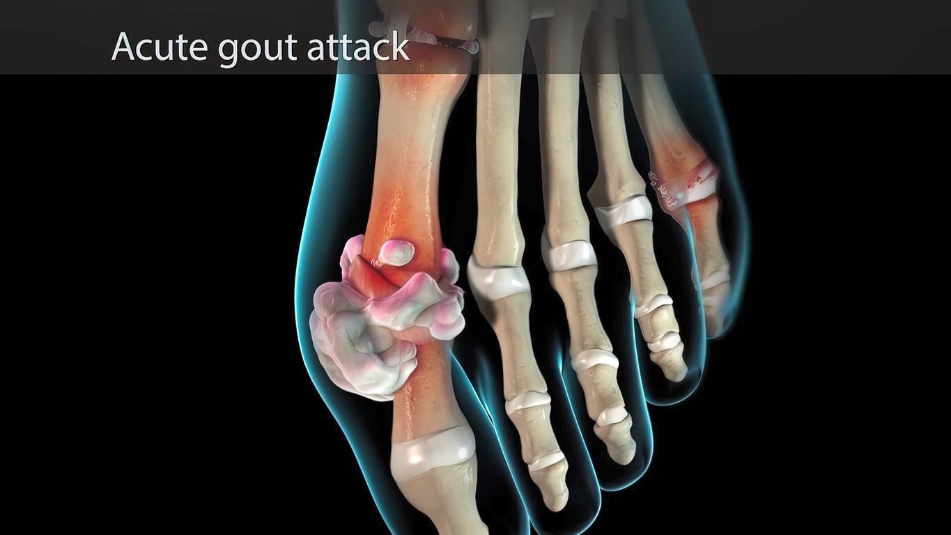 an illustration of an acute gout