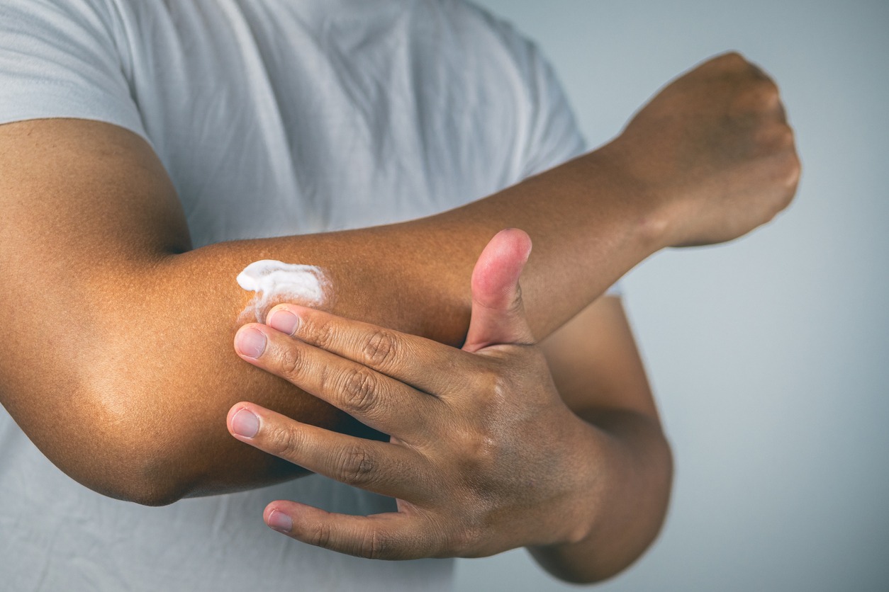 applying anti-inflammatory cream on the arm