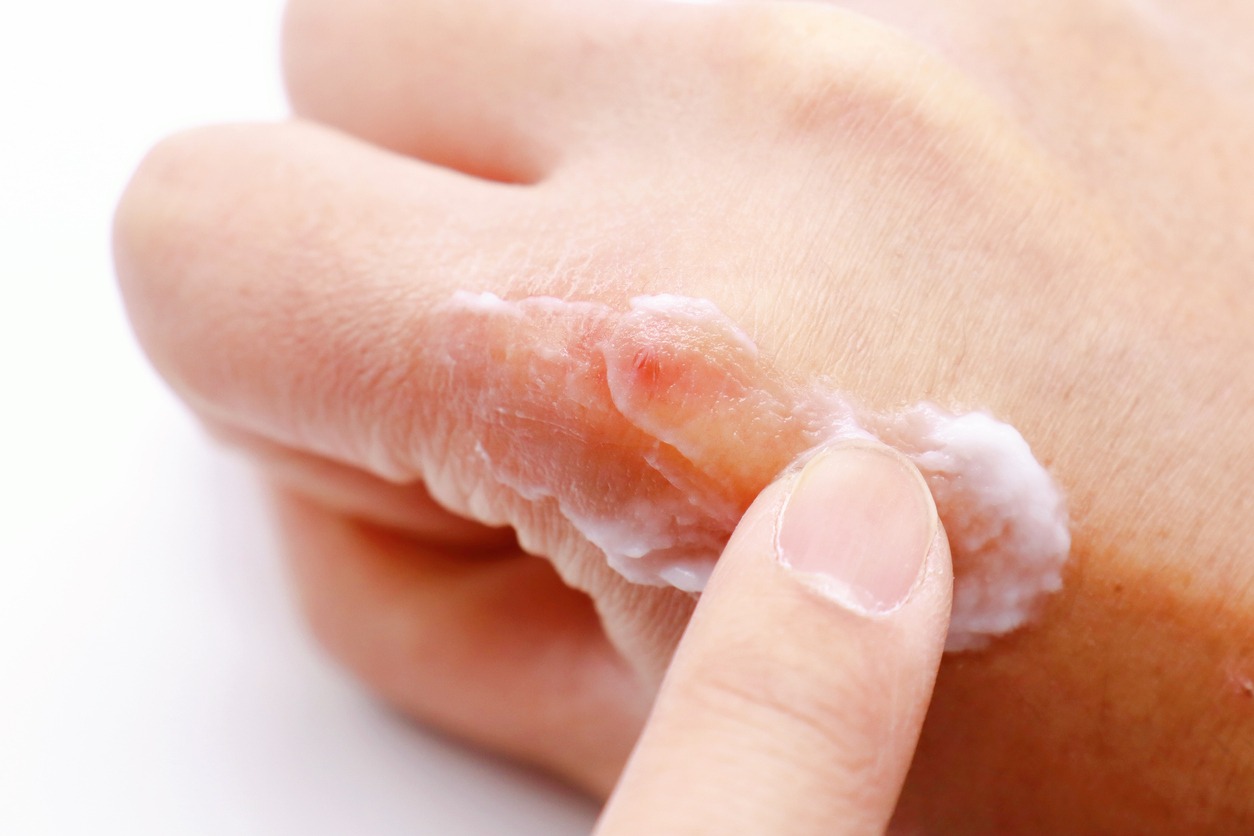 applying cream on wound on the hand