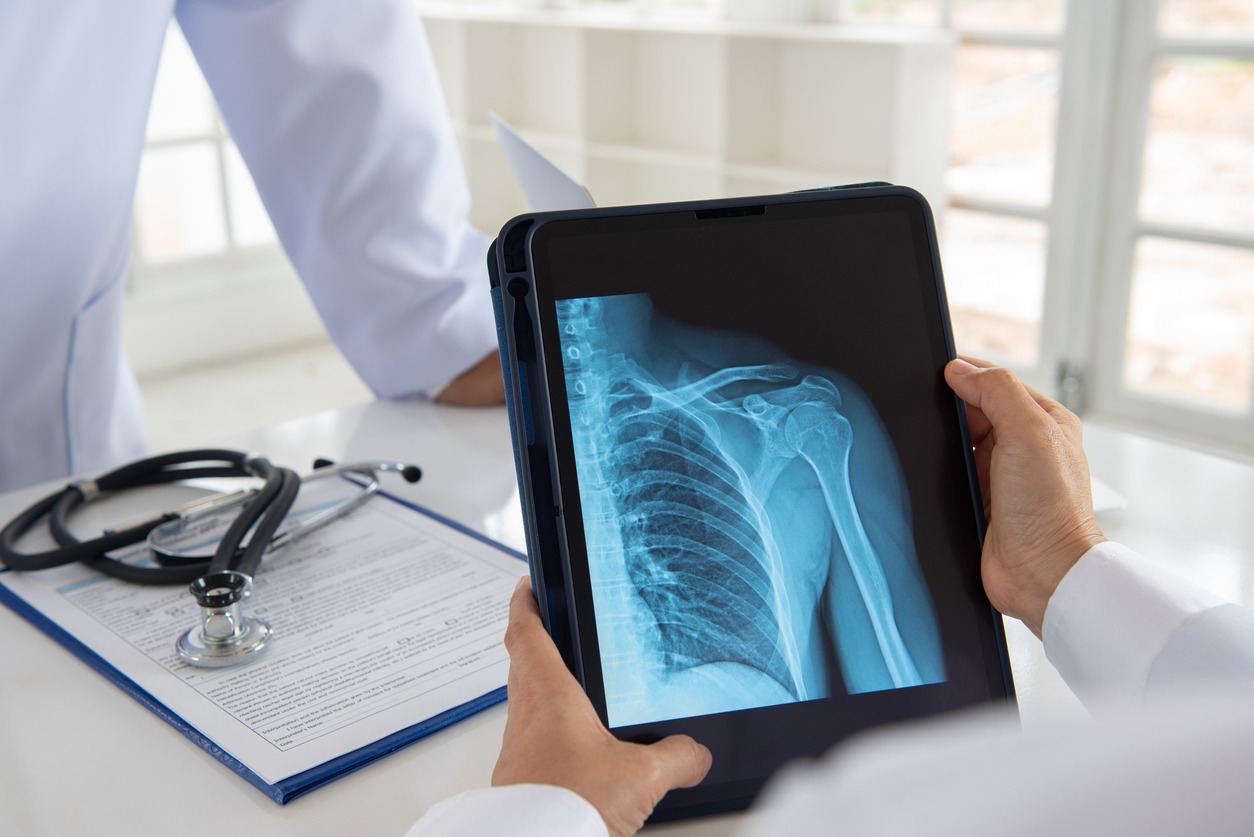 man holding a tablet with a shoulder x-ray result