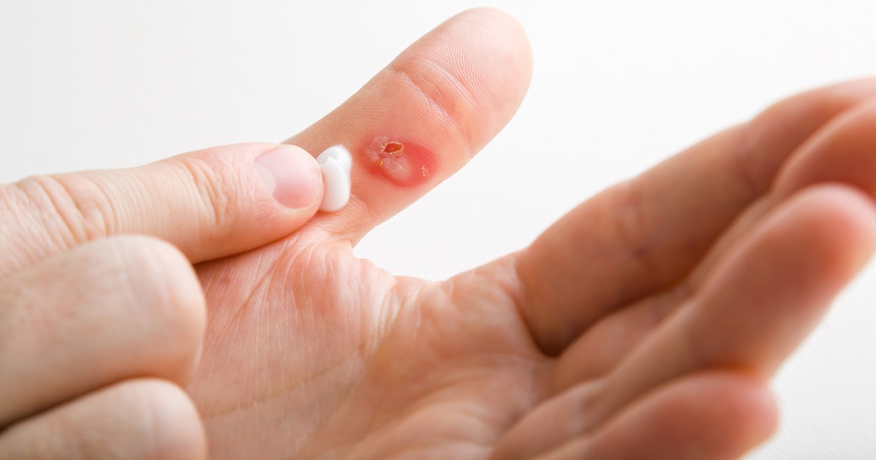 person applying ointment on burned thumb
