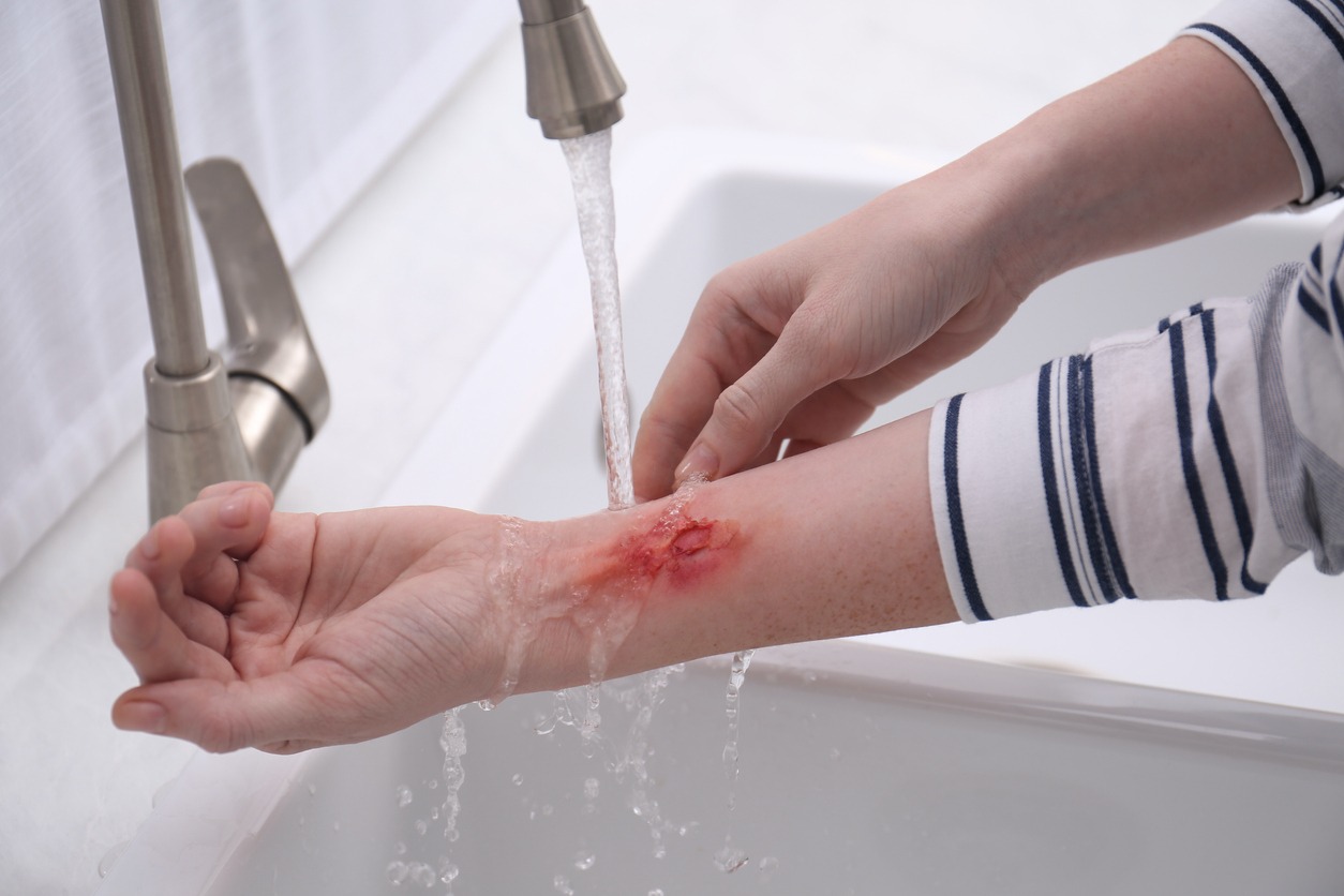 person washing burned arm