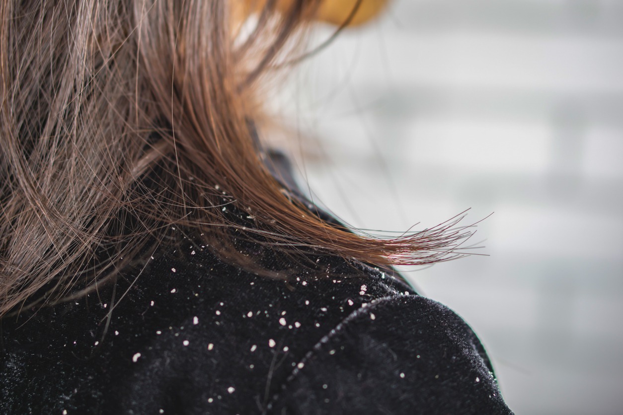 person with dandruff falling on shoulders