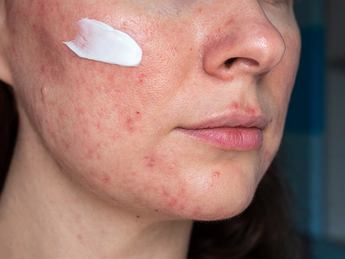 person with medicated ointment on rosacea flare ups