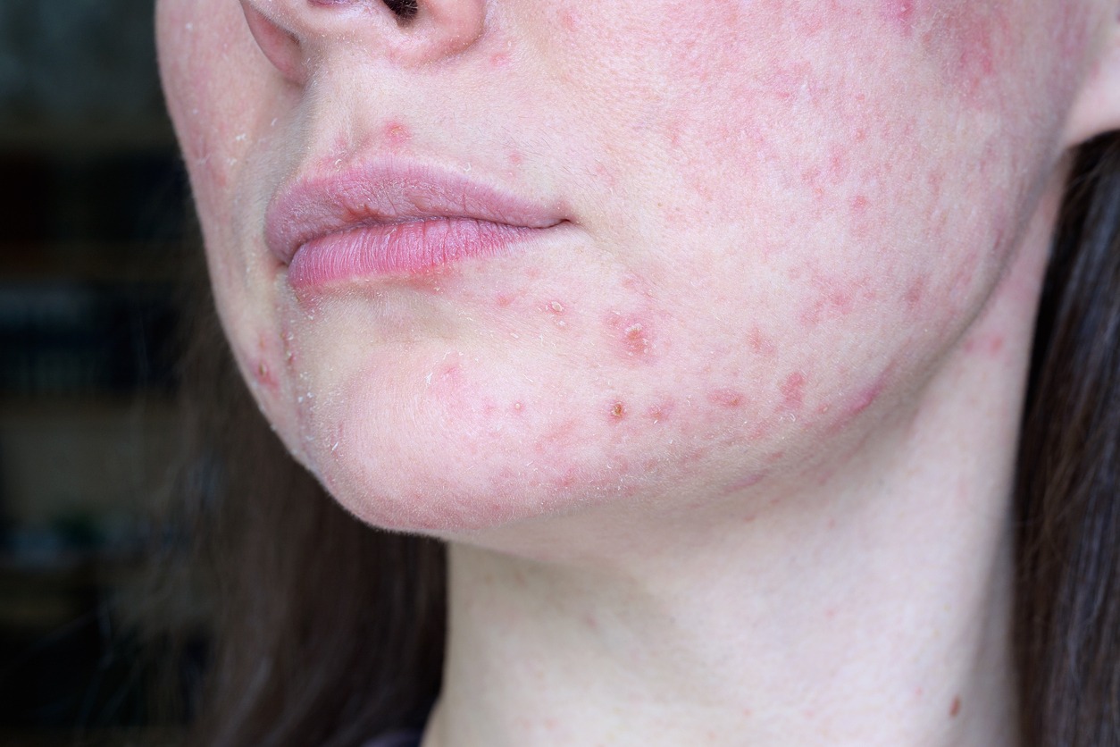 skin with rosacea symptoms