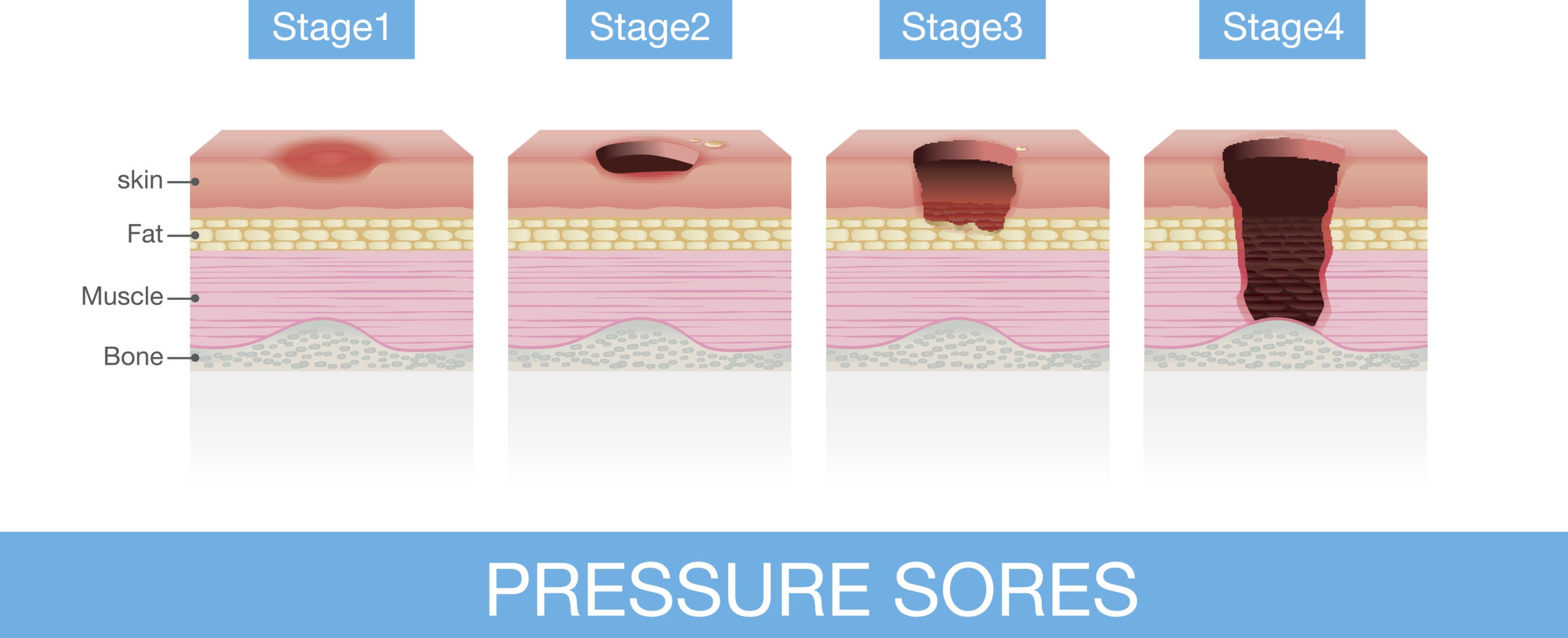 the different stages of bed sores