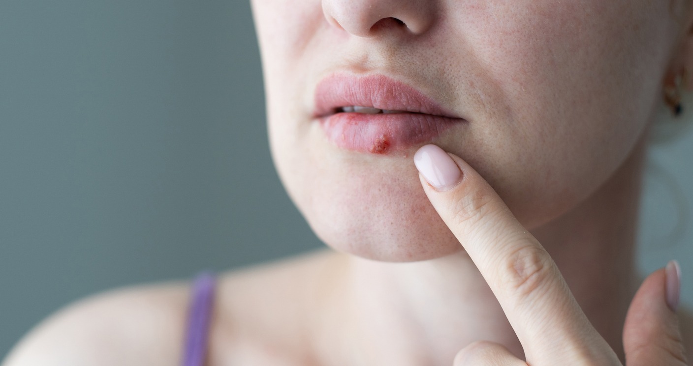 woman with cold sores on the lip
