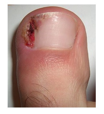 Preventing and Dealing with Ingrown Toenails