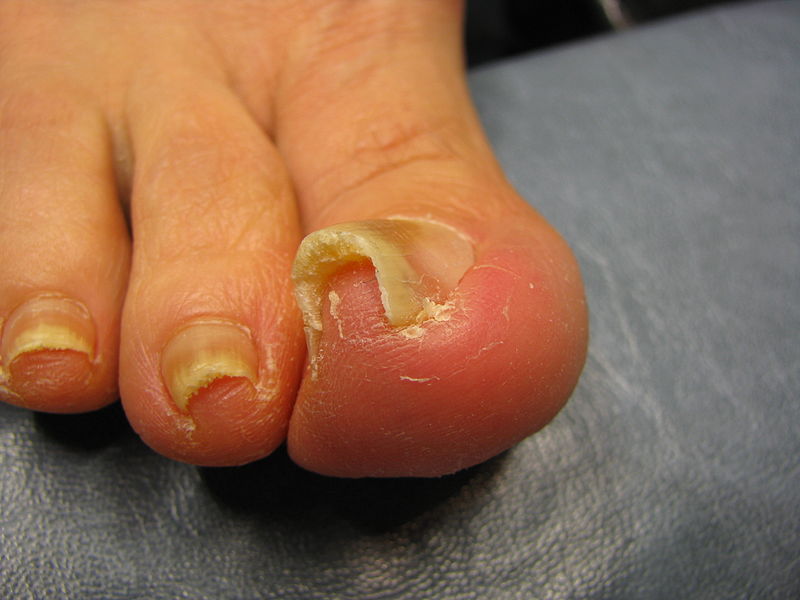 a curved toenail