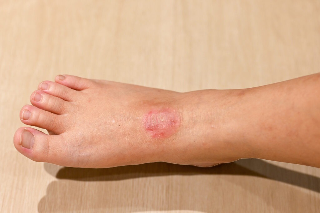 eczema on a foot