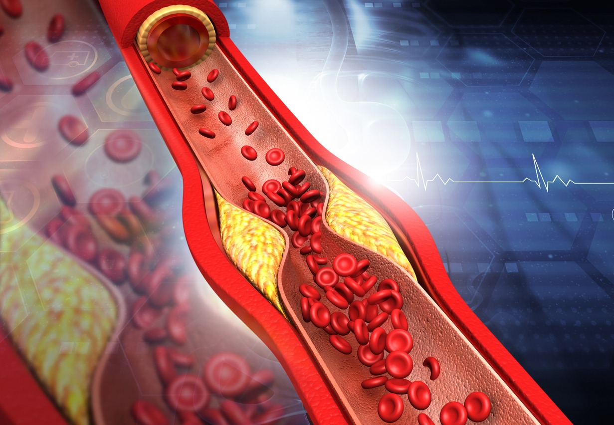 clogged arteries due to plaque