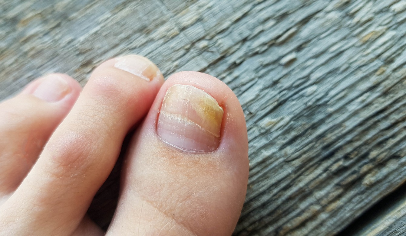 toenail fungus infection