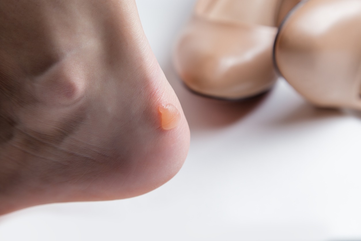 foot with a blister