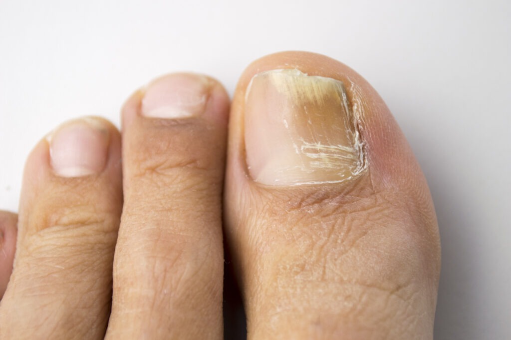 toenail with onychomycosis