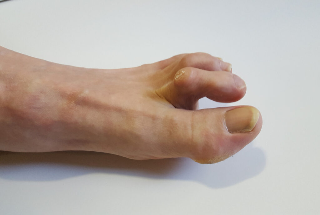 hammer toes image