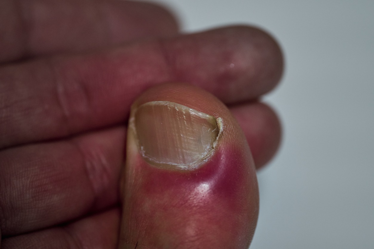 ingrown toenail that causes inflammation and swelling on the skin