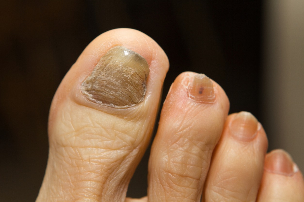 thick toenails that are yellowing due to fungal infection