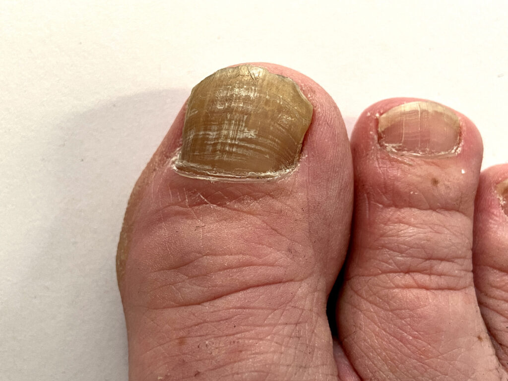 onychomycosis on the nails