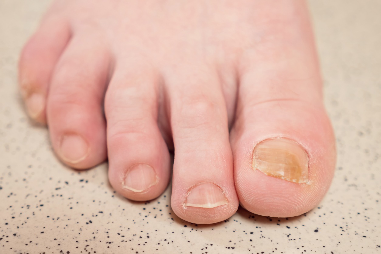 yellowish toenails
