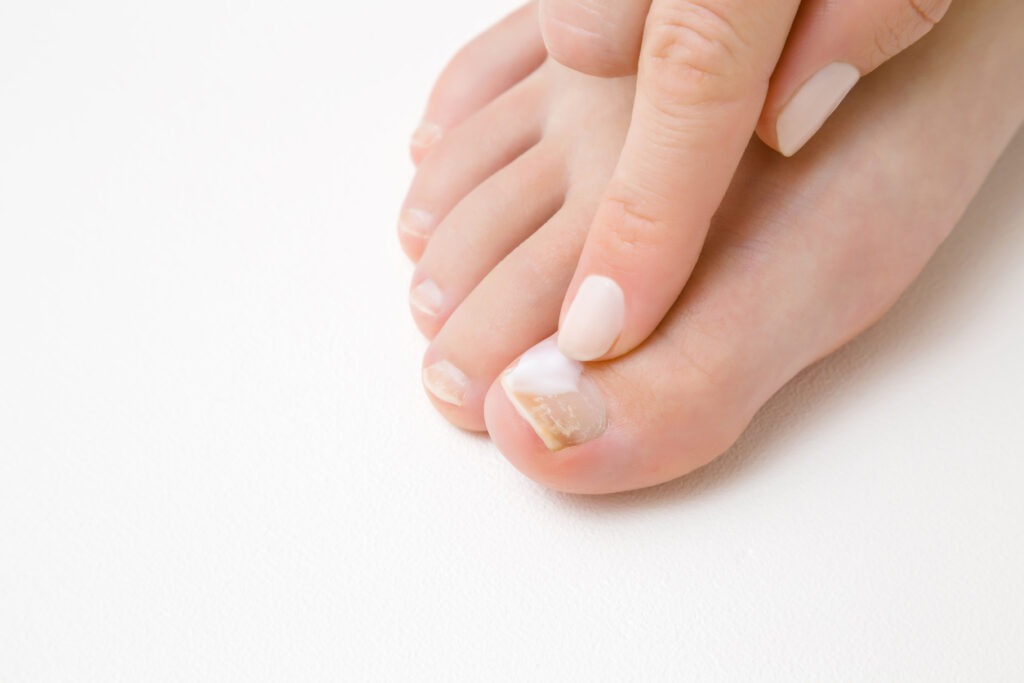 applying cream on an infected toenail