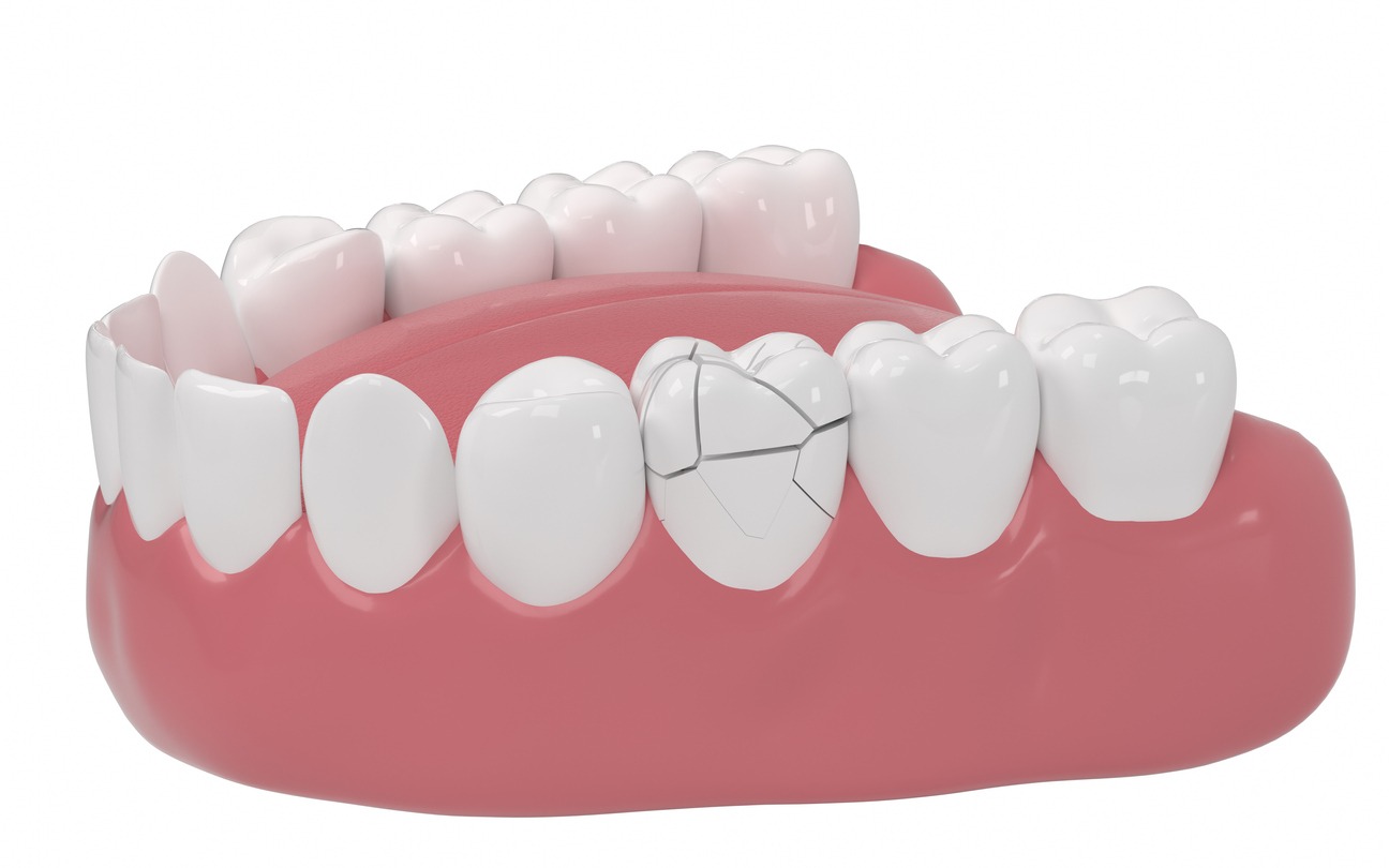 a 3D illustration of a cracked tooth