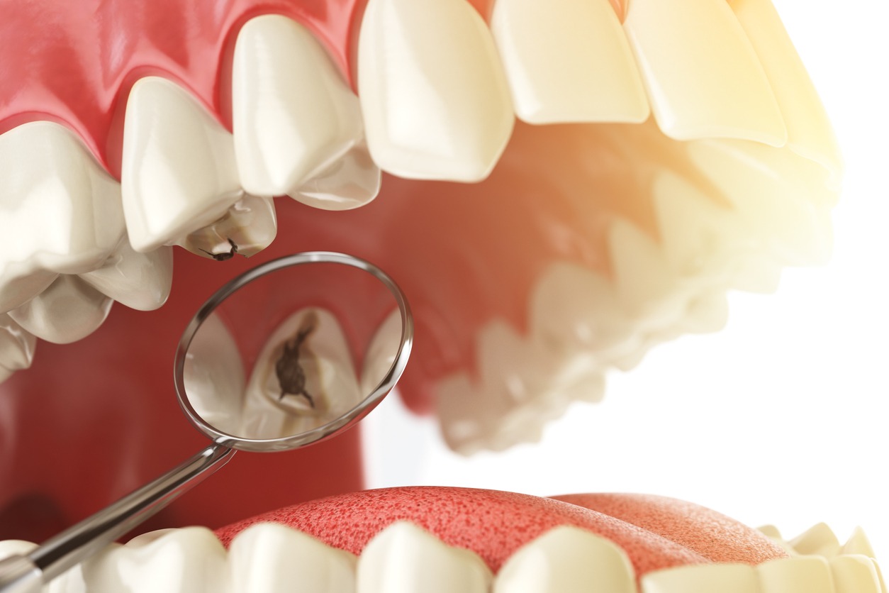 a 3D illustration of dental cavity